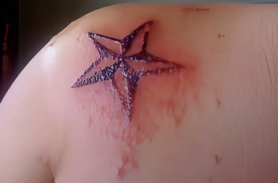 allergic reaction to tattoo ink