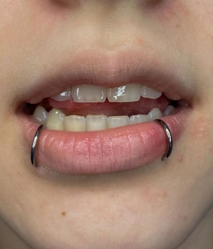 Xỏ Khuyên Miệng: Các Vị Trí, Quy Trình & Chăm Sóc Đúng Cách